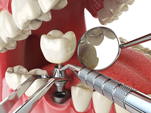 Best Emergency Dentist for Lost Fillings or Crowns in Bradford, RI